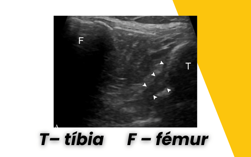 4. Evaluacion rodilla ecografia.png